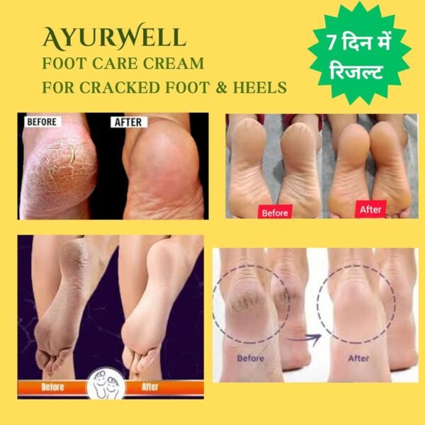AyurWell Foot Care Cream for Cracked, Dry, Dehydrated Foot, Heels and Hands, For Winter, Seasonal, Detergent and All Type of Allergy - Image 2